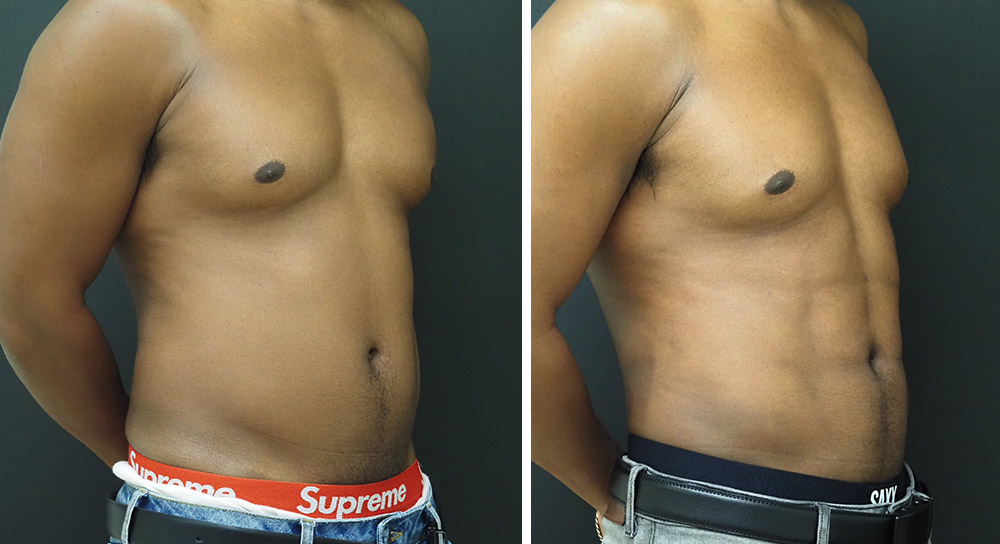 Abdominal Etching Liposuction for Men Vancouver